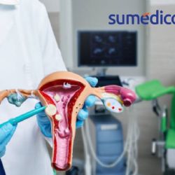 ¿Qué son los miomas uterinos?