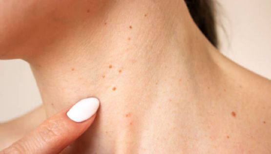 Verrugas: alerta de resistencia a la insulina