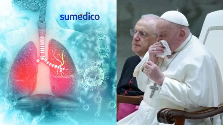 ¿Qué síntomas da la bronquitis persistente que tiene el Papa Francisco?