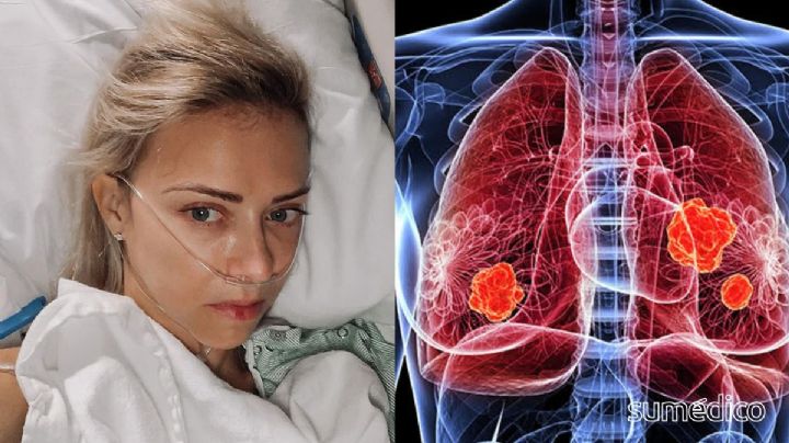 Creí que era solo un tirón muscular, pero tenía cáncer en etapa 4 a los 37 años