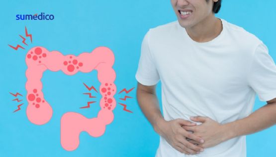 ¿Quieres evitar el cáncer de colon? Este es el alimento que debes comer