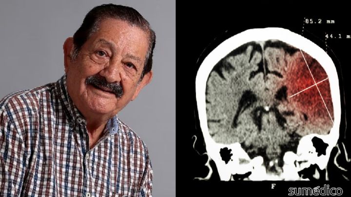 ¿Qué es un infarto cerebral por el que murió Pepe Arévalo 'El León de la salsa'?