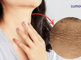¿Qué significa que la piel de tu cuello se esté oscureciendo?