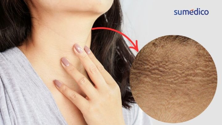 ¿Qué significa que la piel de tu cuello se esté oscureciendo? Conoce la acantosis nigricans