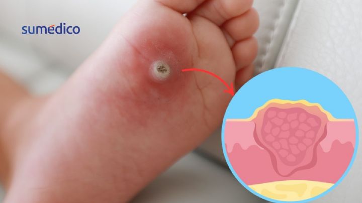 ¿Verrugas en los pies? Estas son las causas de las verrugas plantares