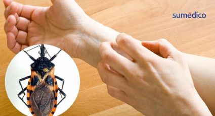 Enfermedad de Chagas: ¿Qué síntomas da y cuál es el insecto que lo transmite?