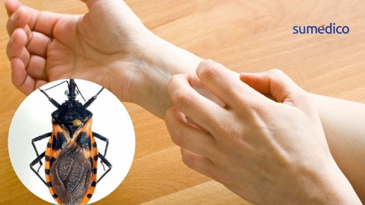 Enfermedad de Chagas: ¿Qué síntomas da y cuál es el insecto que lo transmite?