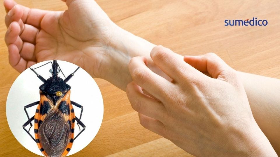 La enfermedad de Chagas puede causar muerte súbita si no se atiende.