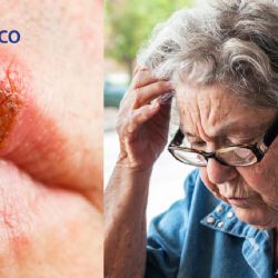 ¿Sufres de fuegos labiales? Podrías tener más riesgo de esta enfermedad