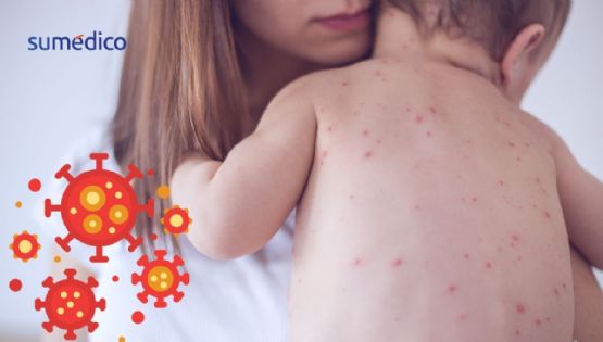 ¿Qué síntomas da el sarampión y qué hacer si mi hijo lo tiene?