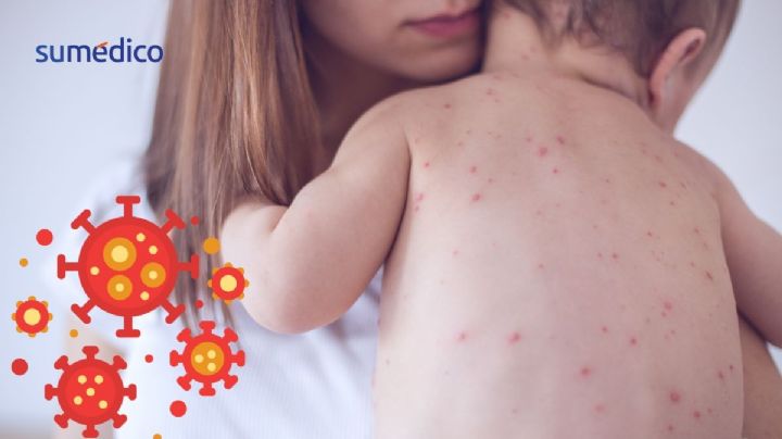 ¿Qué síntomas da el sarampión y qué hacer si mi hijo lo tiene?