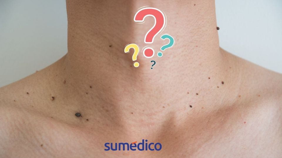 Descubre por qué aparecen verrugas en el cuello