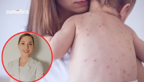 'Más del 90% de casos de sarampión ocurren en pacientes no vacunados o sin refuerzos'