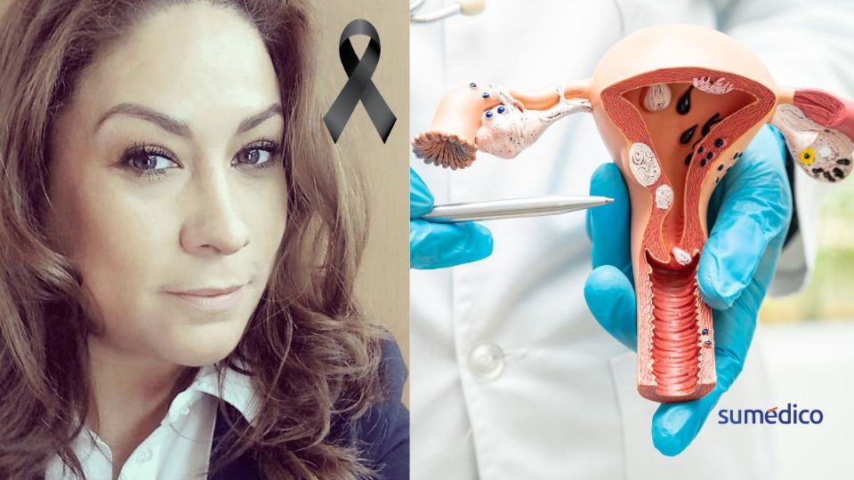 El cáncer cervicouterino tiene una estrecha relación con el VPH.