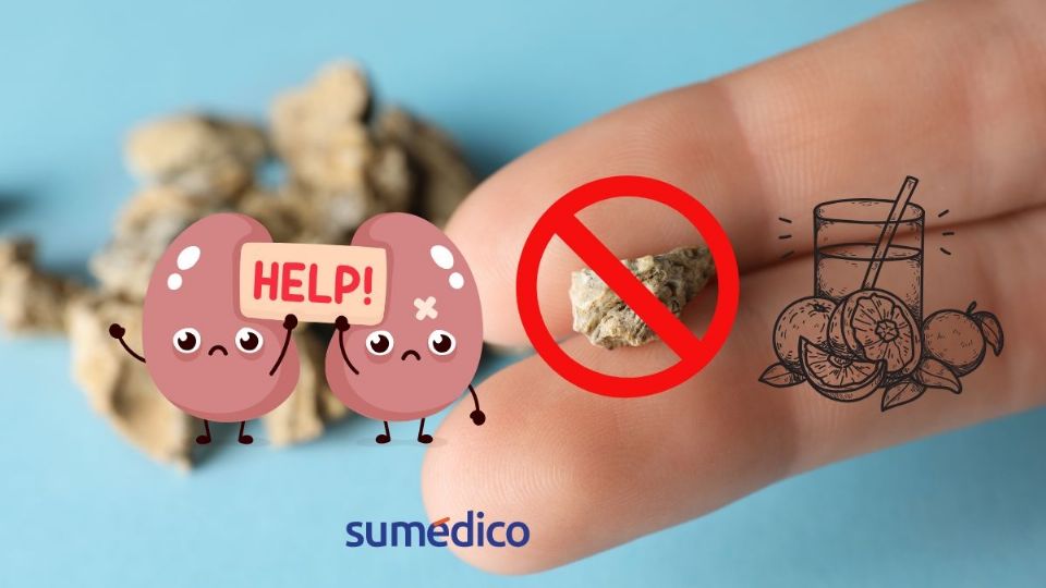 Descubre el jugo para prevenir los cálculos renales