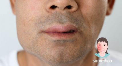 ¿Cómo se manifiesta una parálisis facial por estrés? 5 síntomas que NO debes ignorar