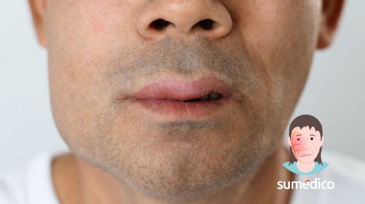 ¿Cómo se manifiesta una parálisis facial por estrés? 5 síntomas que NO debes ignorar