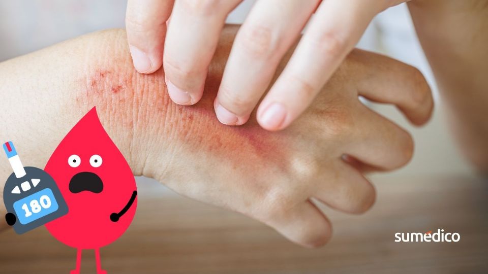 La glucosa alta puede favorecer alteraciones que se notan en la piel.