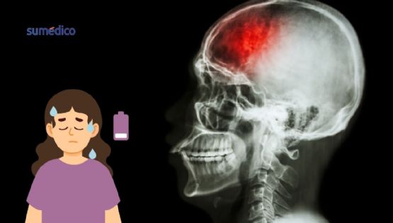 ¿Fatiga constante? Podrías haber sufrido un mini derrame cerebral