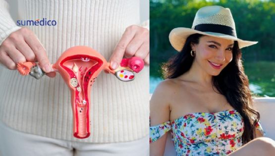 ¿Qué síntomas dan los miomas uterinos como los que le quitaron a Martha Higareda?