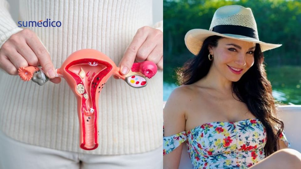 Los miomas uterinos pueden ser silenciosos pero causarte problemas.