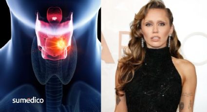 ¿Qué es el edema de Reinke que padece Miley Cyrus y por qué no quiere tratarlo?