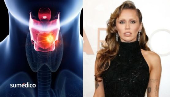 ¿Qué es el edema de Reinke que padece Miley Cyrus y por qué no quiere tratarlo?