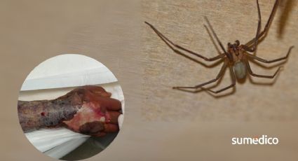 Así salvaron el brazo de un hombre de 75 años que sufrió mordedura de araña violinista