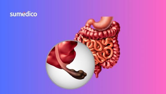 ¿Qué síntomas da el cáncer de apéndice y por qué es más común en millenials?