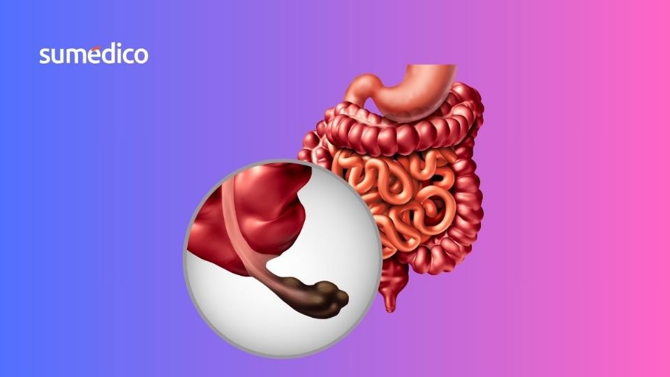 El cáncer de apéndice es una enfermedad muy rara