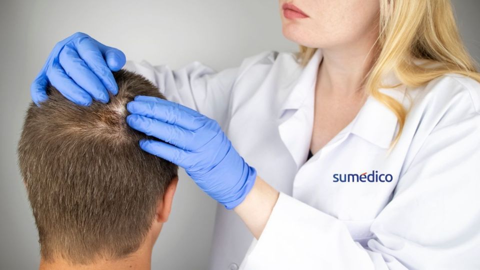 La alopecia es un problema que afecta a muchos hombres y mujeres