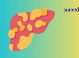 Hígado graso: ¿cómo prevenirlo si tengo diabetes?