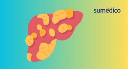 Hígado graso: ¿cómo prevenirlo si tengo diabetes?