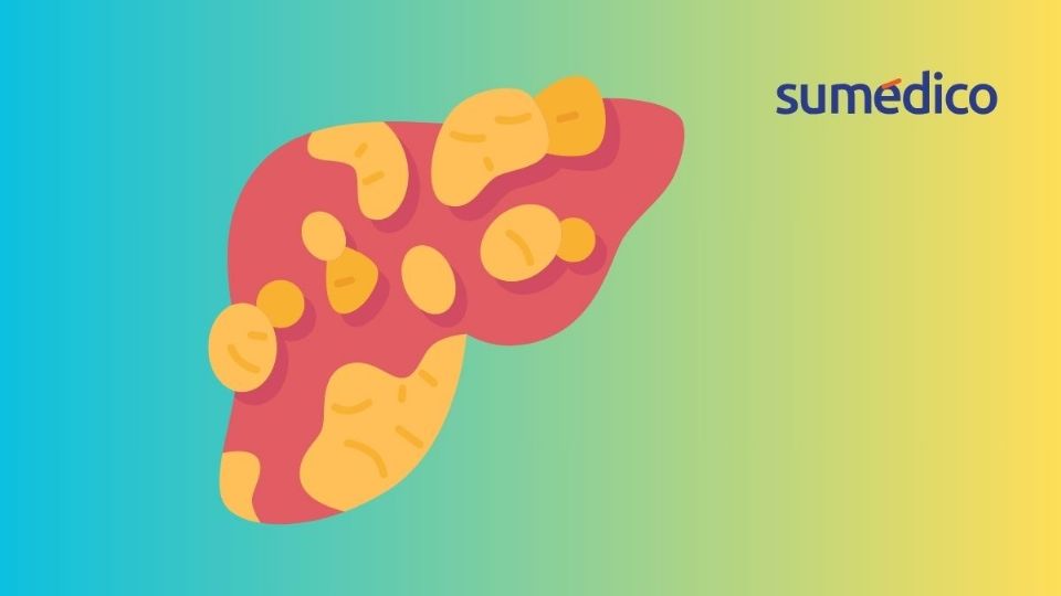 El hígado graso es una complicación común en pacientes con diabetes