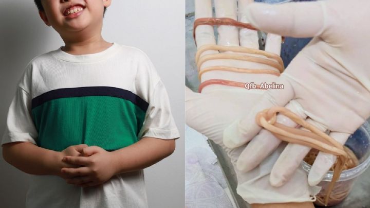 Así encontraron más de 140 parásitos intestinales en un niño de Chiapas