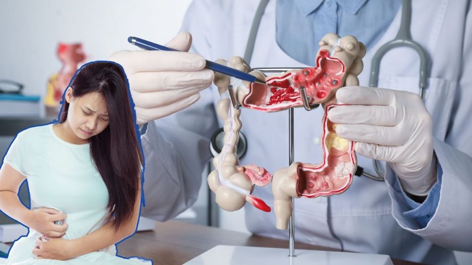 Una alimentación baja en fibra aumenta el riesgo de esta condición.