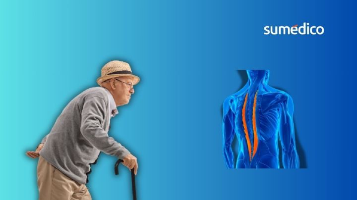 ¿Qué es el síndrome post-caída y por qué afecta a adultos mayores?