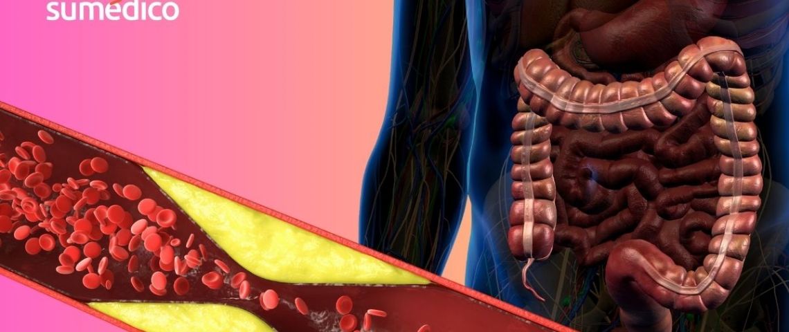 ¿Cómo influyen las bacterias intestinales en la obstrucción de las arterias?