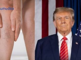 Qué es la insuficiencia venosa crónica que padece Donald Trump y cómo afecta