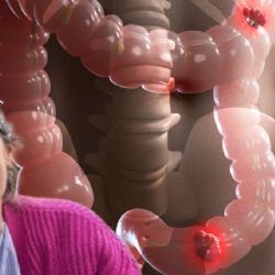 ‘Creí que eran síntomas de perimenopausia, pero tenía cáncer de intestino’