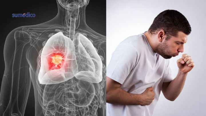 Cáncer de pulmón sin fumar: Estudio revela el factor invisible que lo causaría
