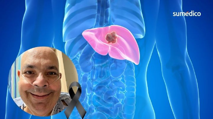 ¿Qué causa el cáncer de hígado y pulmón que sufrió el comediante Carlos Merced?