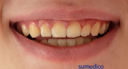 ¿Qué malos hábitos provocan que tus dientes se manchen?