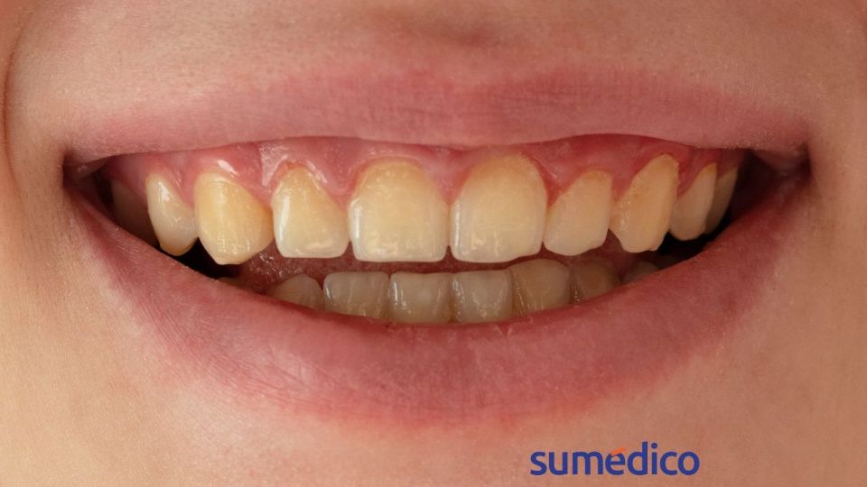 Conoce los malos hábitos provocan que tus dientes se manchen