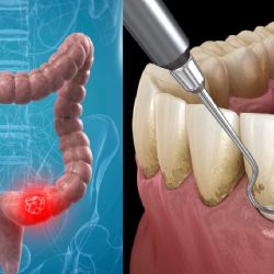 ¿Tienes este problema en las encías? Podrías tener mayor riesgo de cáncer colorrectal