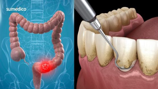 La señal en tus encías que alerta MÁS riesgo de cáncer colorrectal