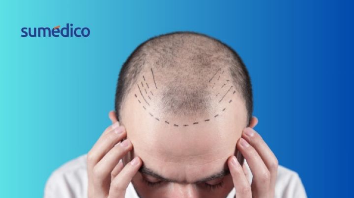 ¿Te atreverías a hacerte un trasplante capilar? Conoce los riesgos antes de decidir