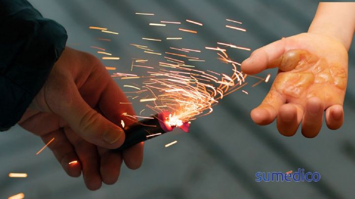 Qué hacer en caso de quemaduras por pirotecnia estas fiestas patrias