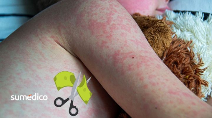 Recorte presupuestal y desatención: las razones detrás del resurgimiento del sarampión en México