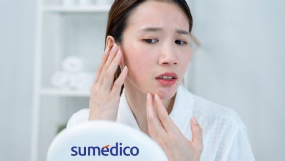 ¿Qué es la dermatitis seborreica?